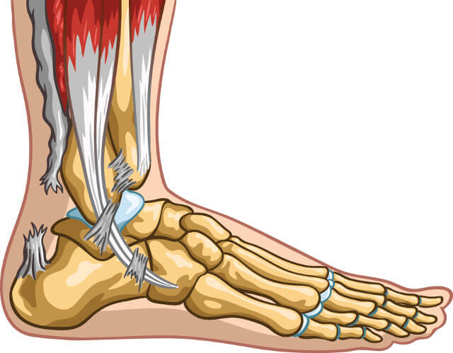 Achilles Tendon Rupture