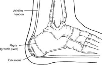 Calcaneal Apophysitis (Sever’s Disease)