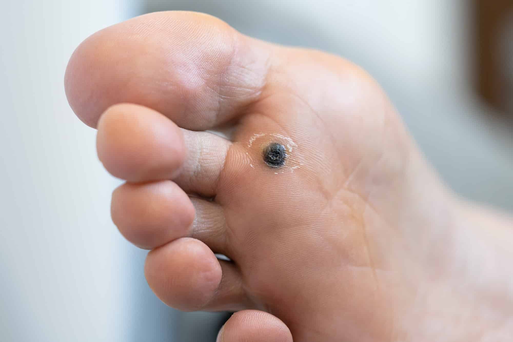 plantar warts