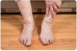 Diabetic Foot Care