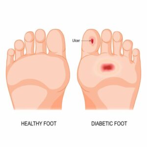 diabetic foot illustration