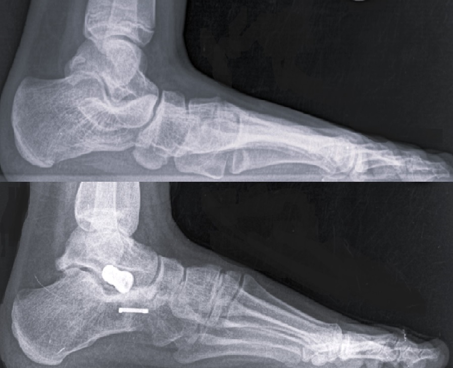 Before and After Flat Foot Correction Surgery