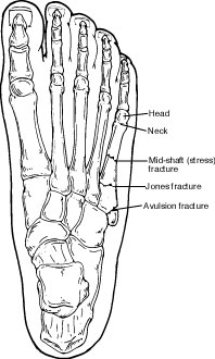 Fifth Metatarsal Fractures