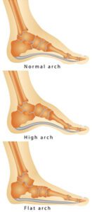 Flat Foot Treatment