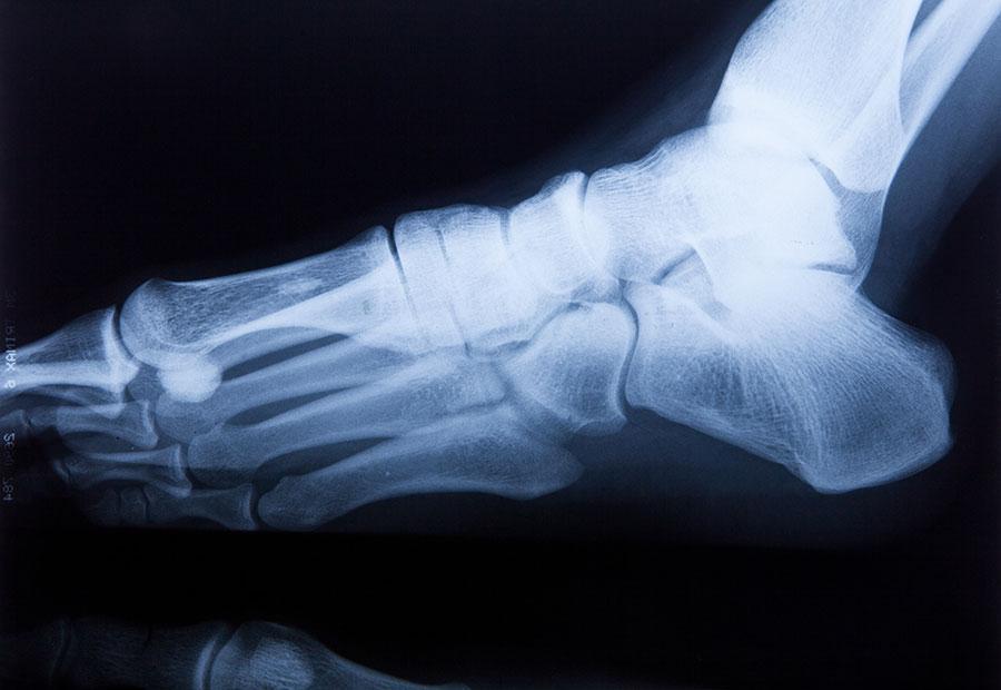 Foot and Ankle Fractures