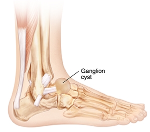 Ganglion Cyst