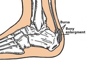 Haglund’s Deformity