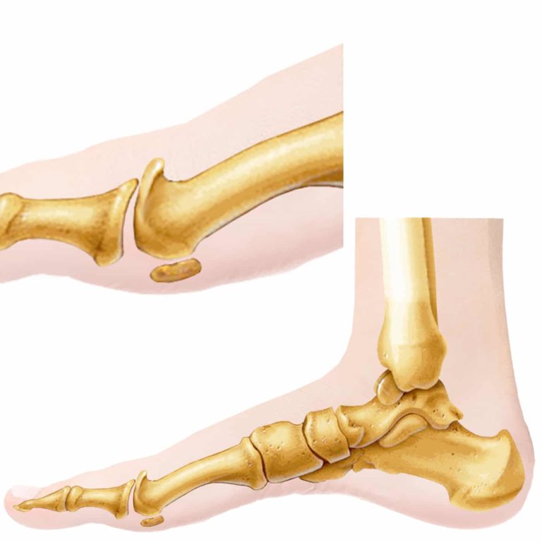 Hallux Rigidus