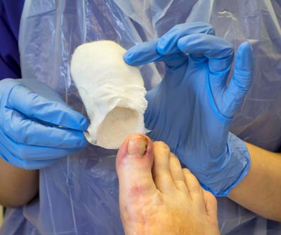 Ingrown Nail Treatment