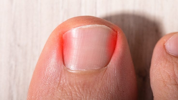 Ingrown Toenail