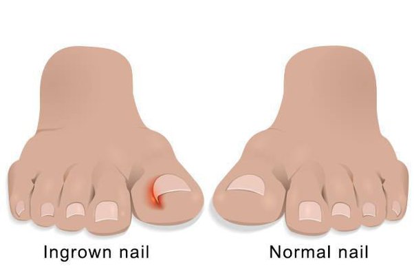 Ingrown Toenails