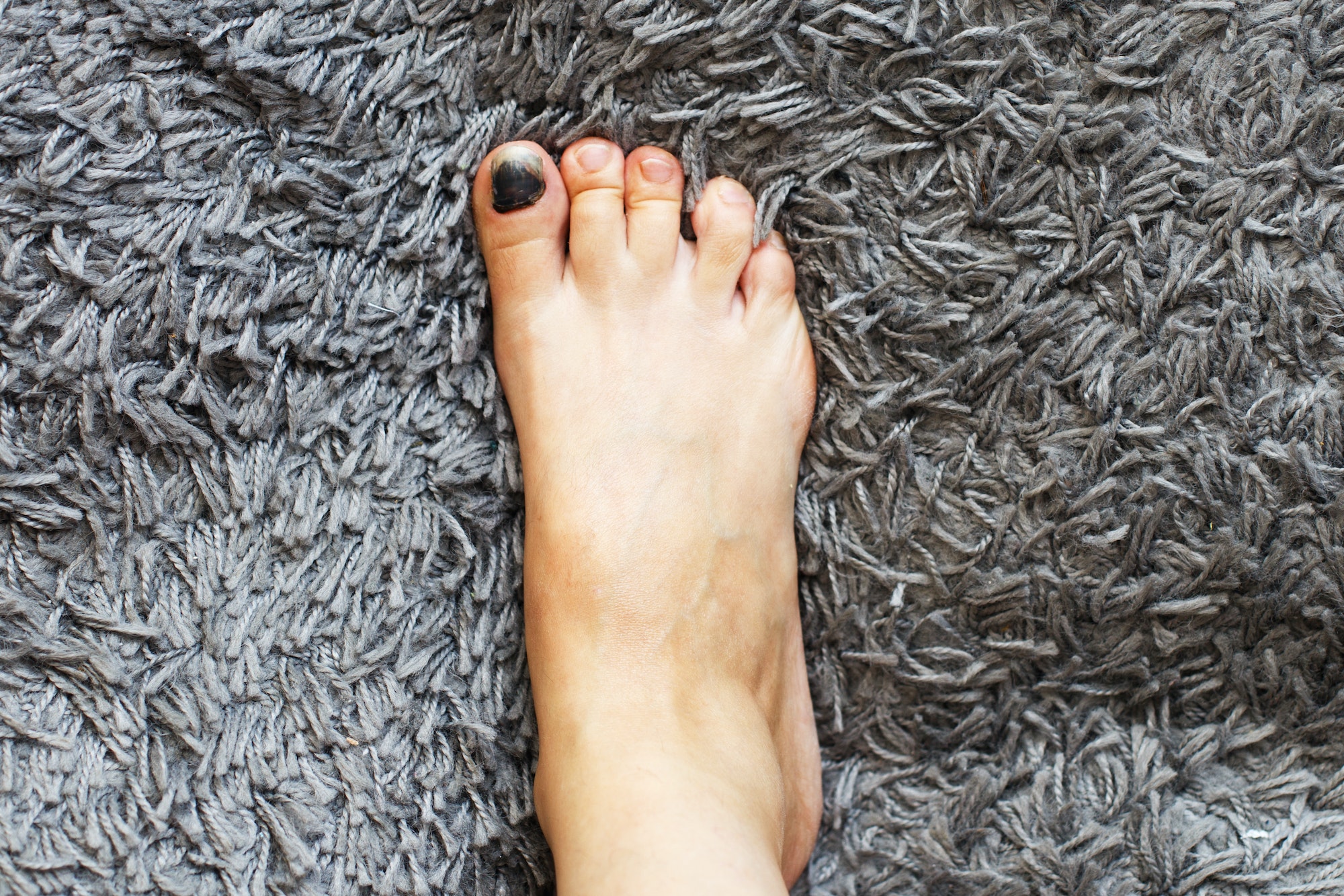 toenails discolored