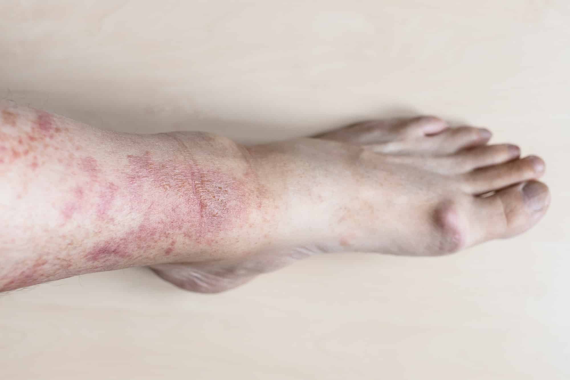 Skin Disorders and Rashes