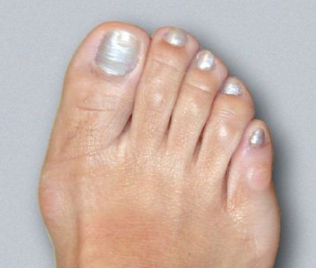 Mild Bunion