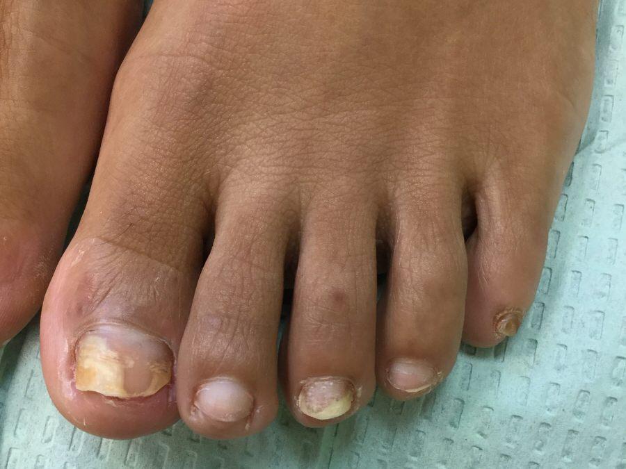 Nail Fungus