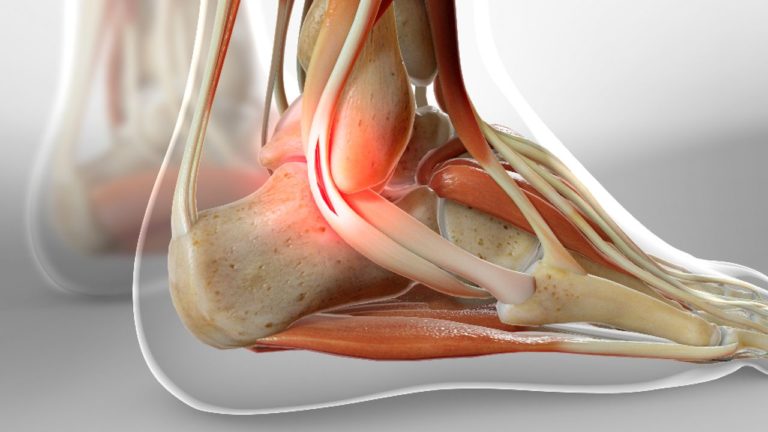 Peroneal Tendon Injuries