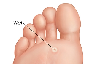 Plantar Wart (Verruca Plantaris)