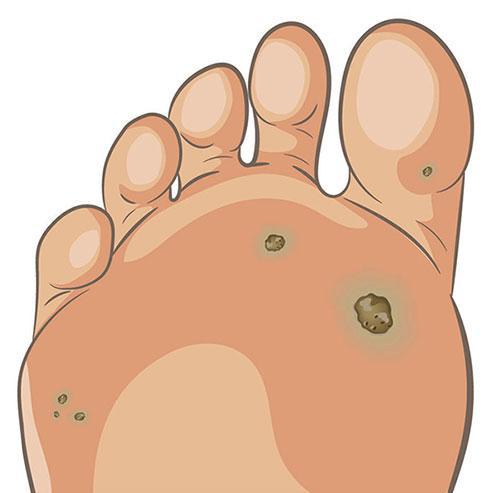 Plantar Warts