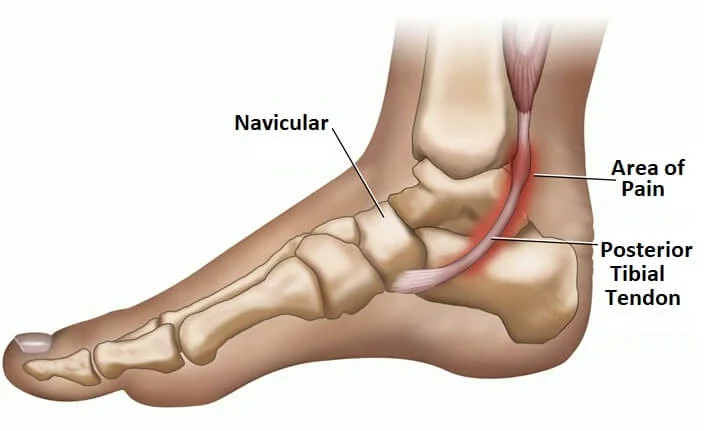 Posterior Tibial Tendon Dysfunction (PTTD)