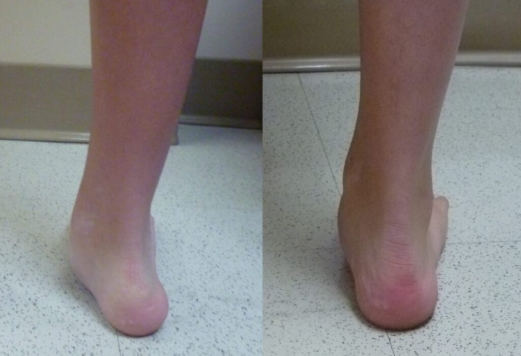 Before and After Overpronation Correction Surgery