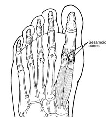 Sesamoid Injuries