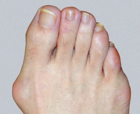 severe bunion