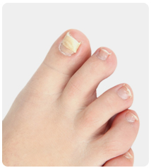 Toenail Fungus Or Ingrown Toenail