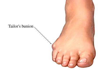 Tailor’s Bunion - Bunionette