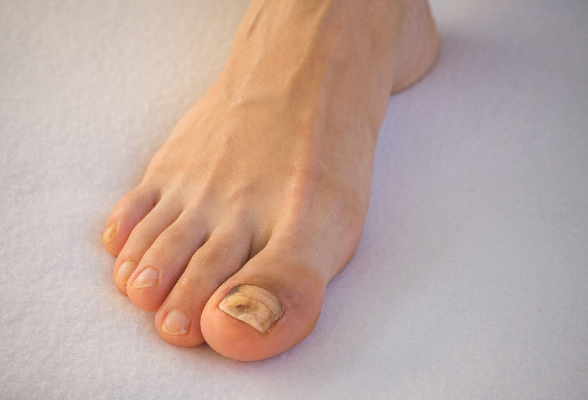 Toenail Fungus