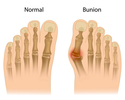 Bunion