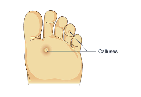 Calluses and Corns