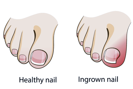 Ingrown Toenail