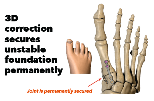 Lapiplasty® 3D Bunion Correction after