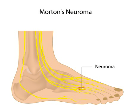 Neuroma