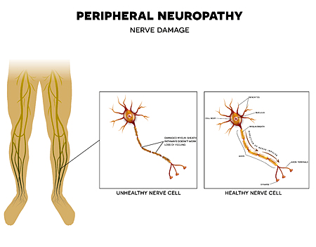 Neuropathy