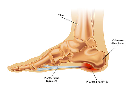 Plantar Fasciitis