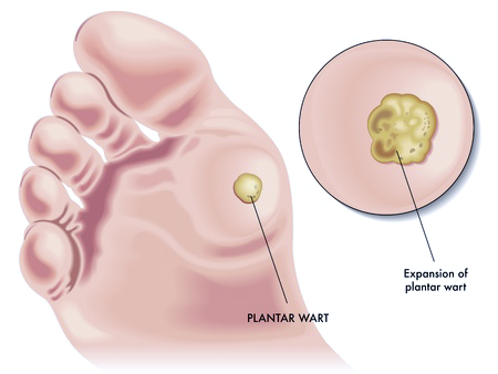 Warts Treatment