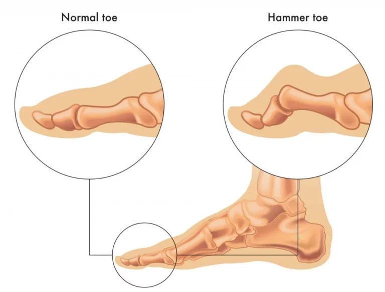 Treating Hammertoes